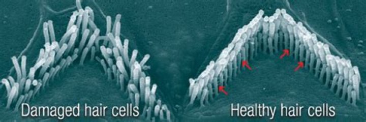 Can damaged hair cells be repaired?
