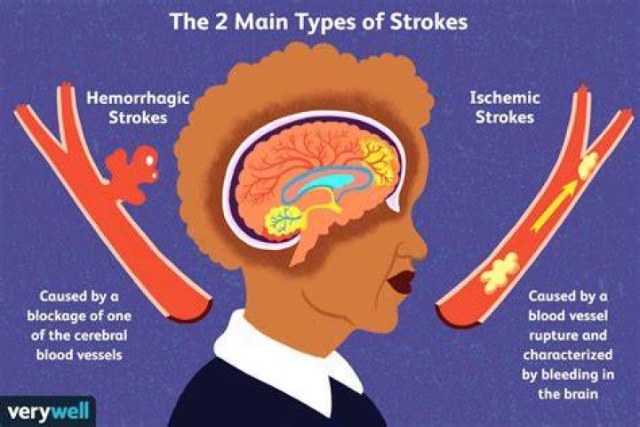 Do mini strokes make you tired?