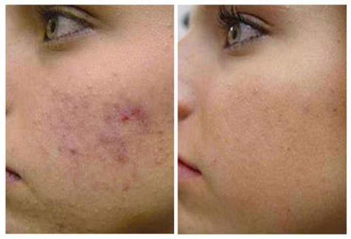 Does Retinol heal acne scars?