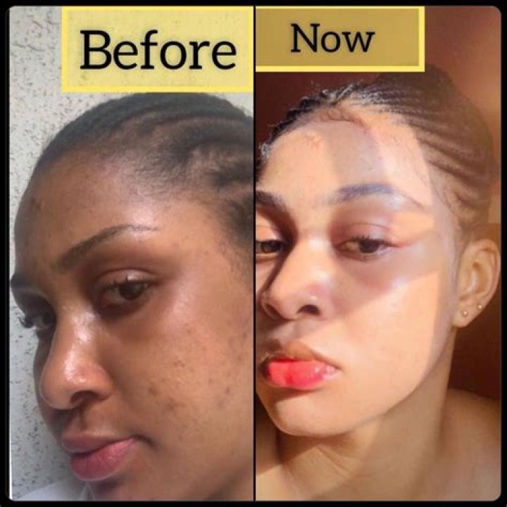 How do I bleach my skin?