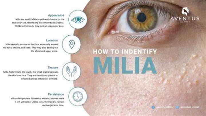How do you get rid of a milia bump?