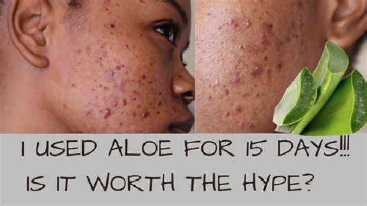 How long does aloe vera take to fade scars?