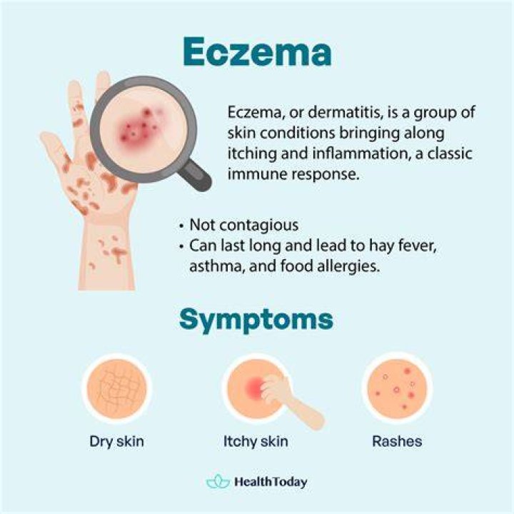 Is eczema autoimmune Related?