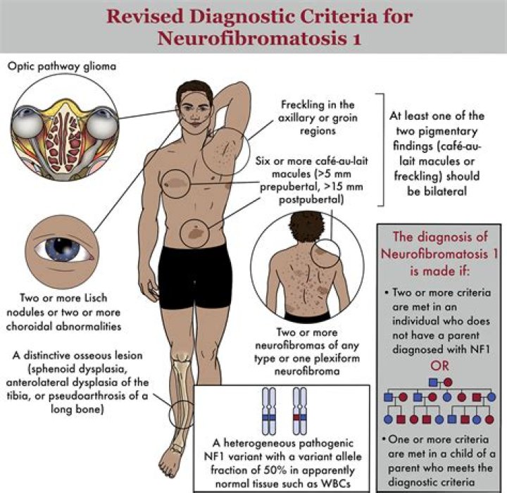Is there a cure coming soon for neurofibromatosis?