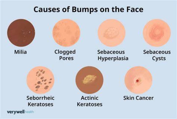 What are the bumps on my face that aren't pimples?