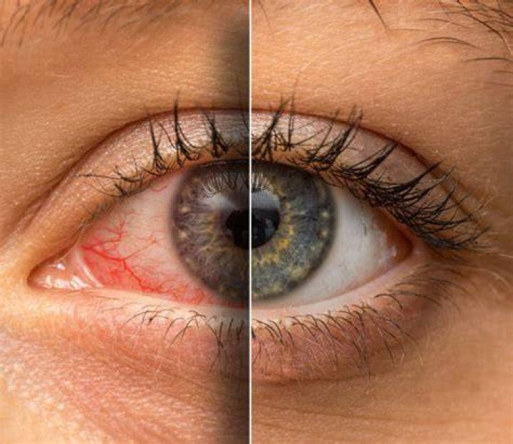 Why do eyes become red?